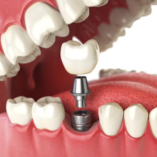 implantes dentários ilustração explicação estrutura componentes