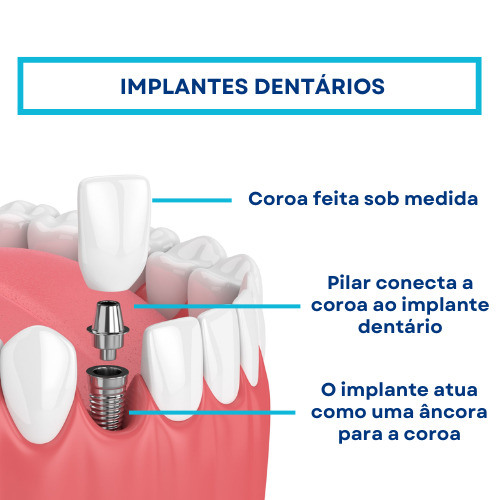 implantes dentários ilustração explicação estrutura componentes