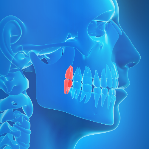 Imagem ilustrativa de um dente do siso e sua localização na arcada dentária, destacando a importância da avaliação odontológica para determinar a necessidade de extração.