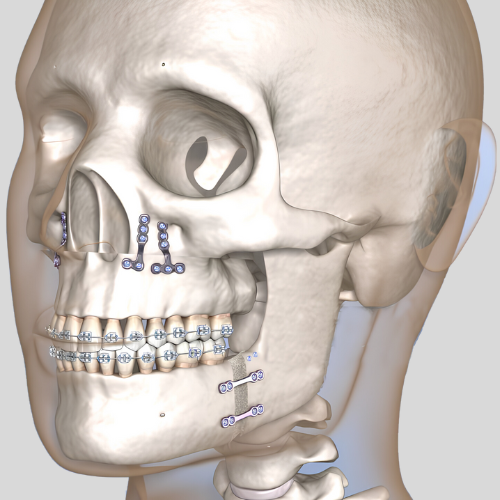 Imagem de antes e depois da cirurgia ortognática mostrando correção de irregularidades nos ossos faciais e maxilares, destacando melhorias estéticas e funcionais após o procedimento.